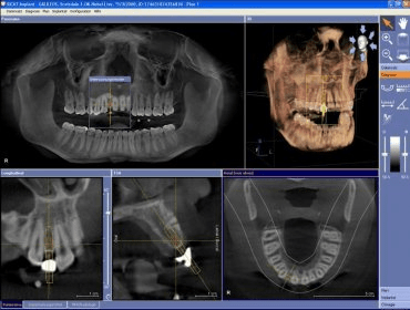 SICAT Implant Download - Radiological 3D software for dental diagnostics