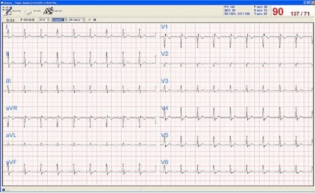 Qrs