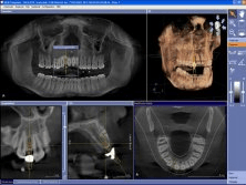 Download GALILEOS Implant by SICAT