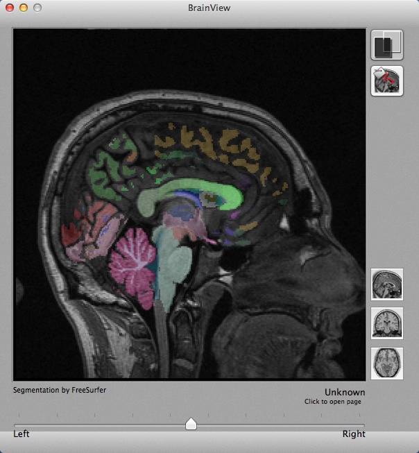 iSurf BrainView 1.0 : Lateral Brain View
