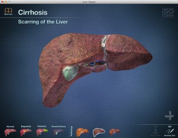 Cirrhosis Animation Window