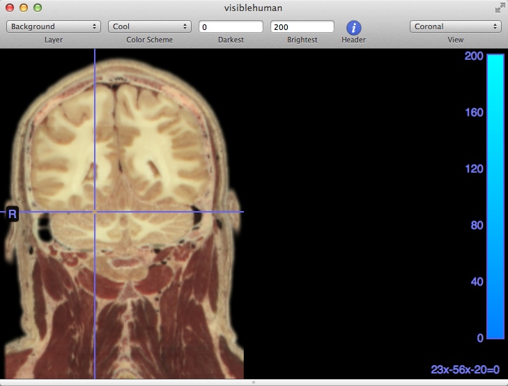MRIcro 1.8 : Coronal View
